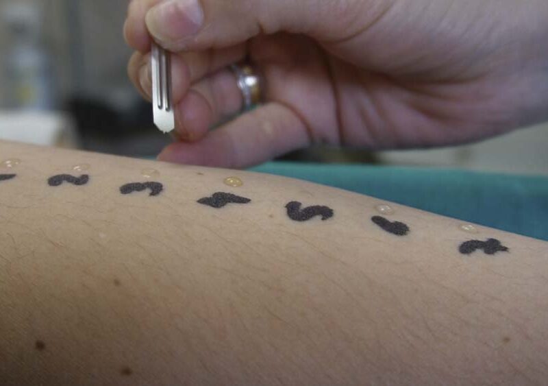 Prueba de la alergia. - Junta de Andalucía