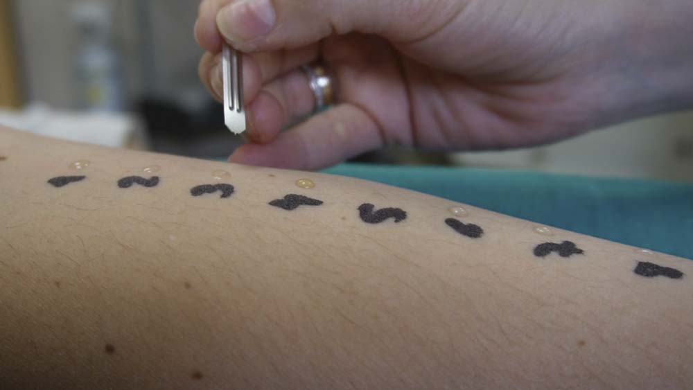 Prueba de la alergia. - Junta de Andalucía