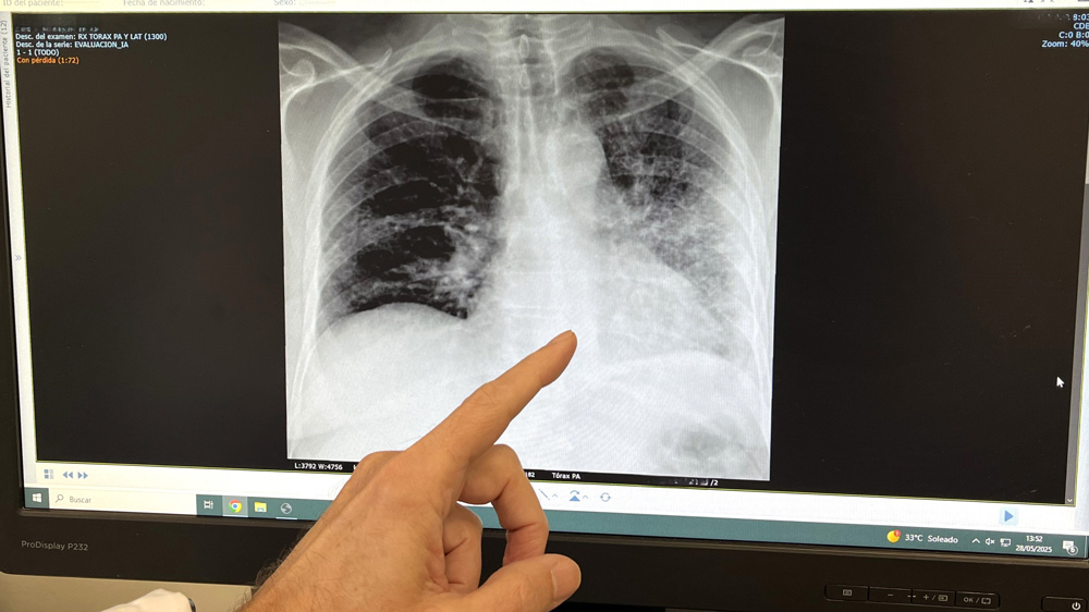 Foto RX de un paciente fumador con cáncer de pulmón. - QuirónSalud